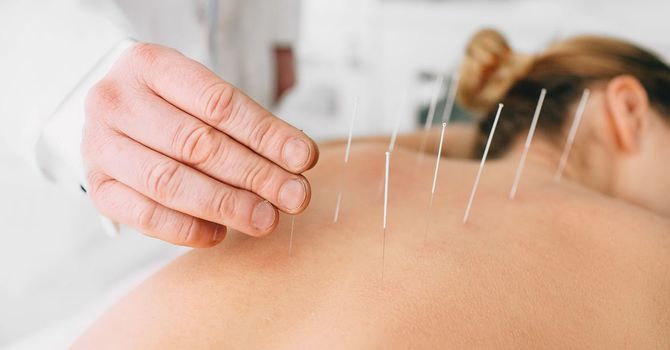 Acupuncture