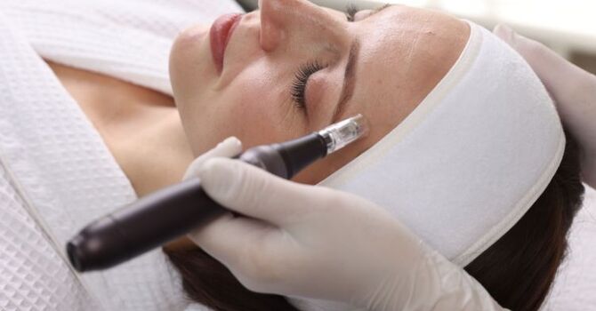 Does Microneedling Really Work for Acne Scars?